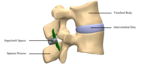 Diagram of lower back pain