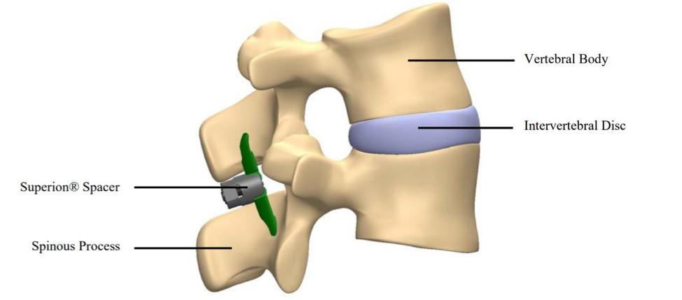 Diagram of lower back pain